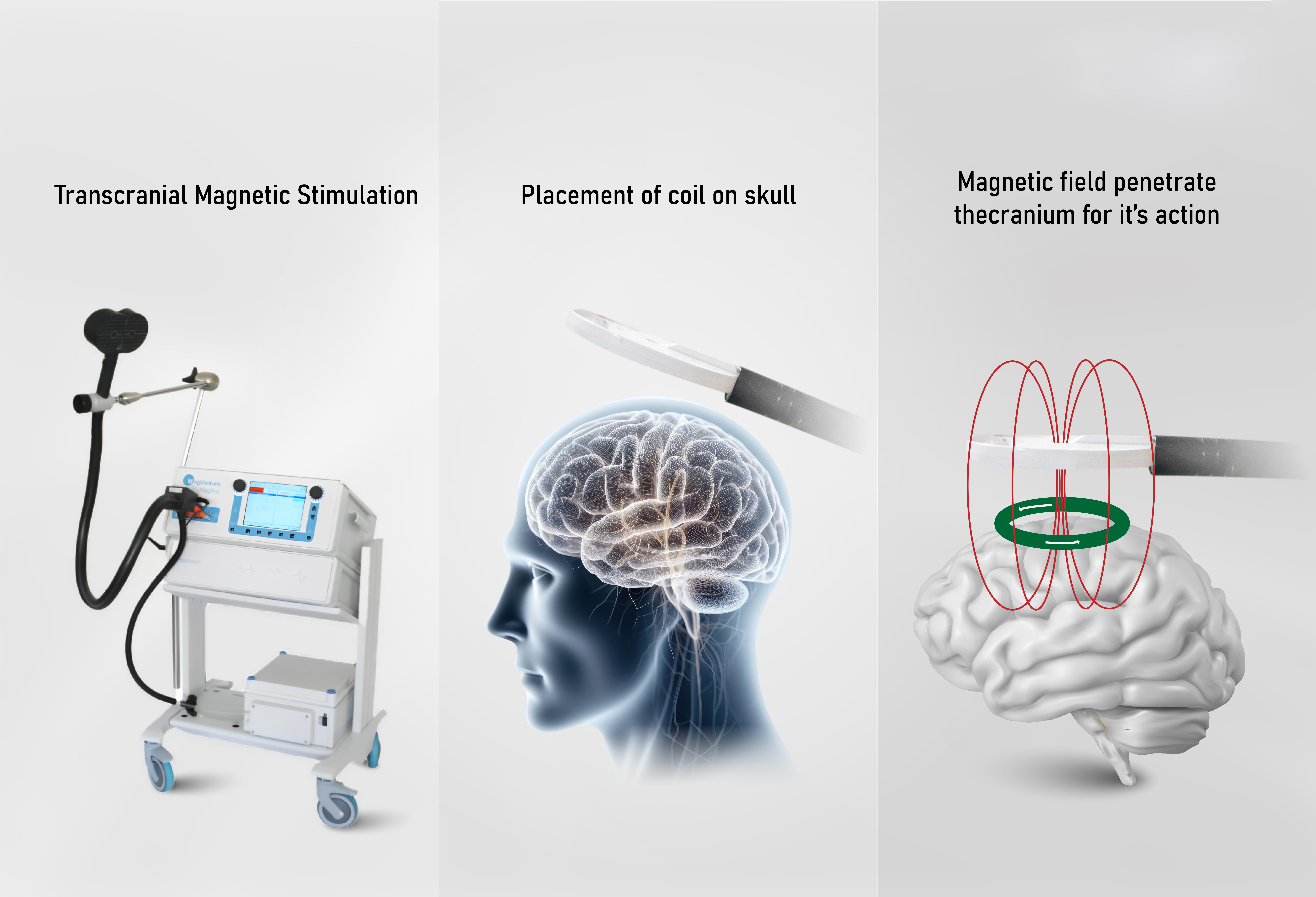 ขั้นตอนการรักษาด้วย TMS เข้าใจง่ายใน 5 นาที